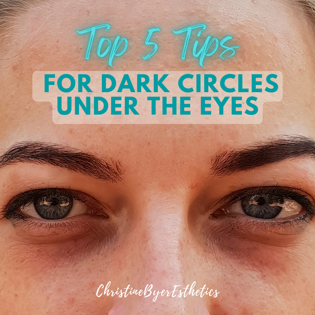 Top 5 Tips for Dark Circles Under the Eyes