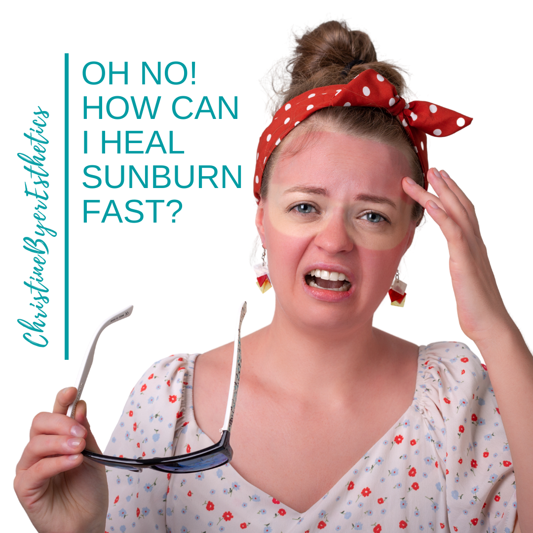 Oh No! How Can I Heal Sunburn Fast?