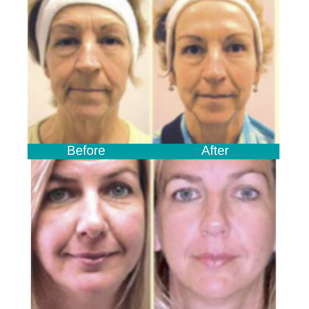 A Must-Know Alternative to Invasive Cosmetic Procedures