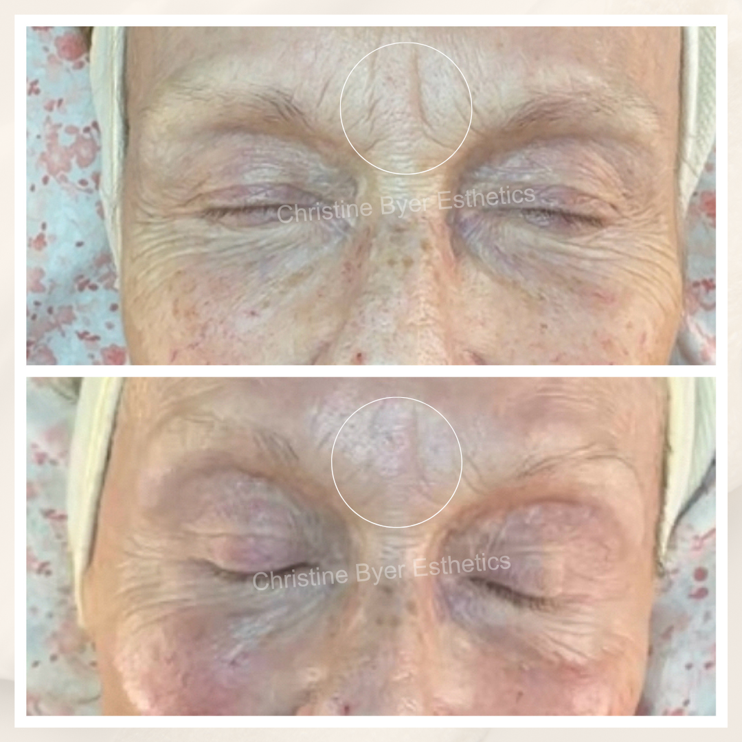 Rejuvenate Your At-Home Skincare with Peels