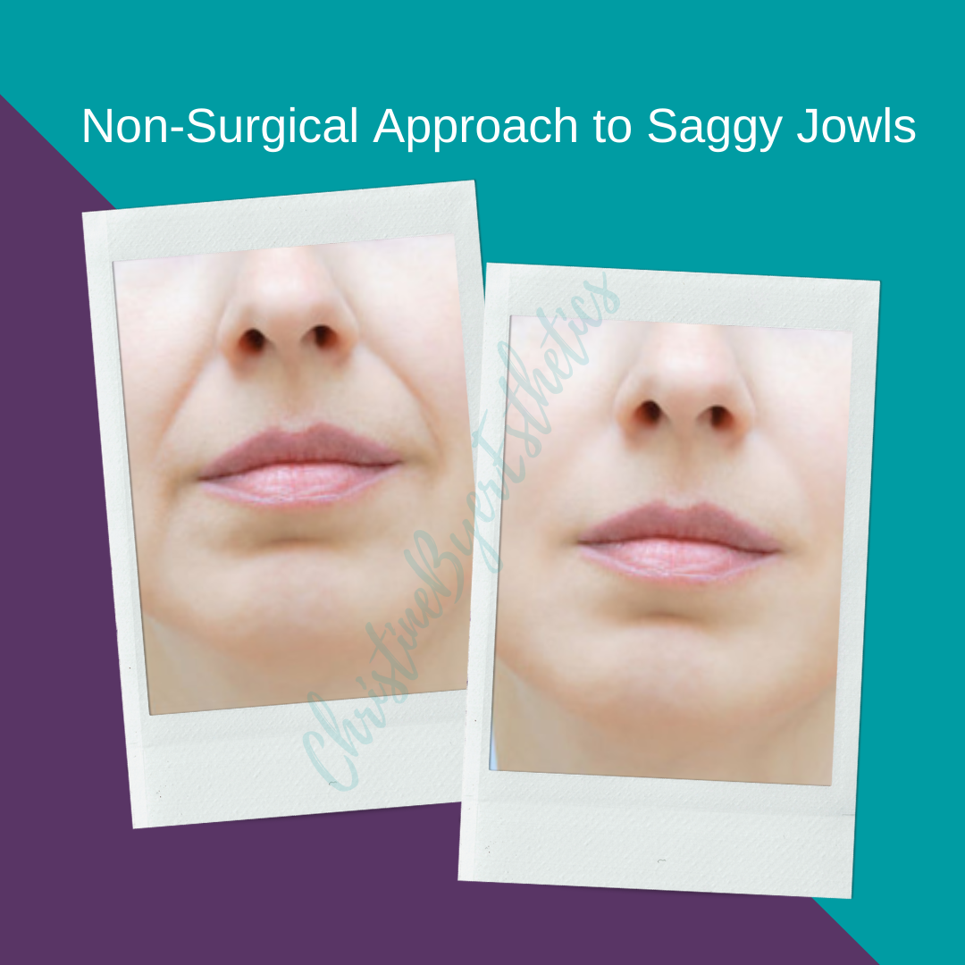 A Non-Surgical Approach to Saggy Jowls