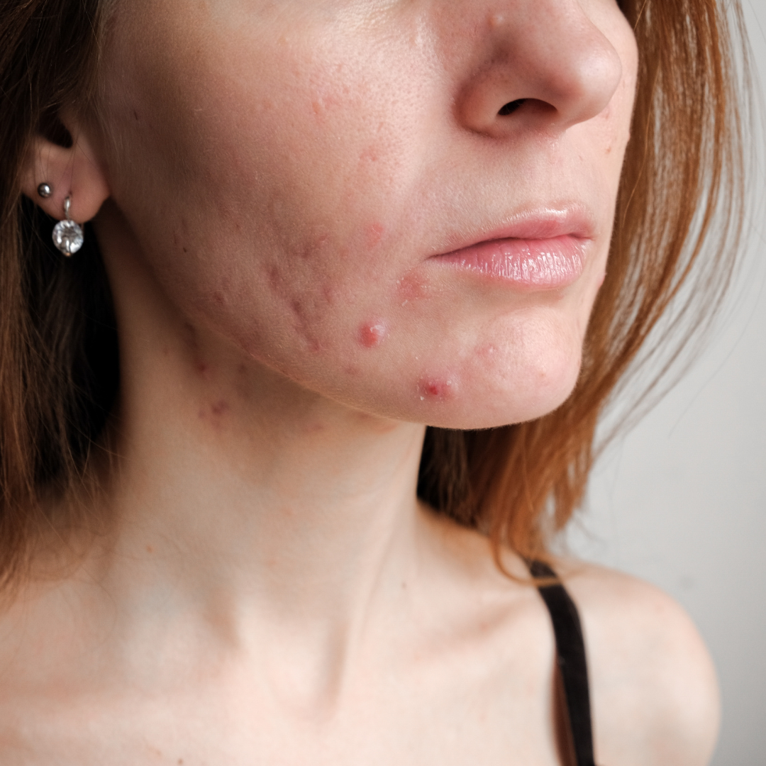 Breakouts in Middle-Aged Women; What Causes Them and How to Fix Them