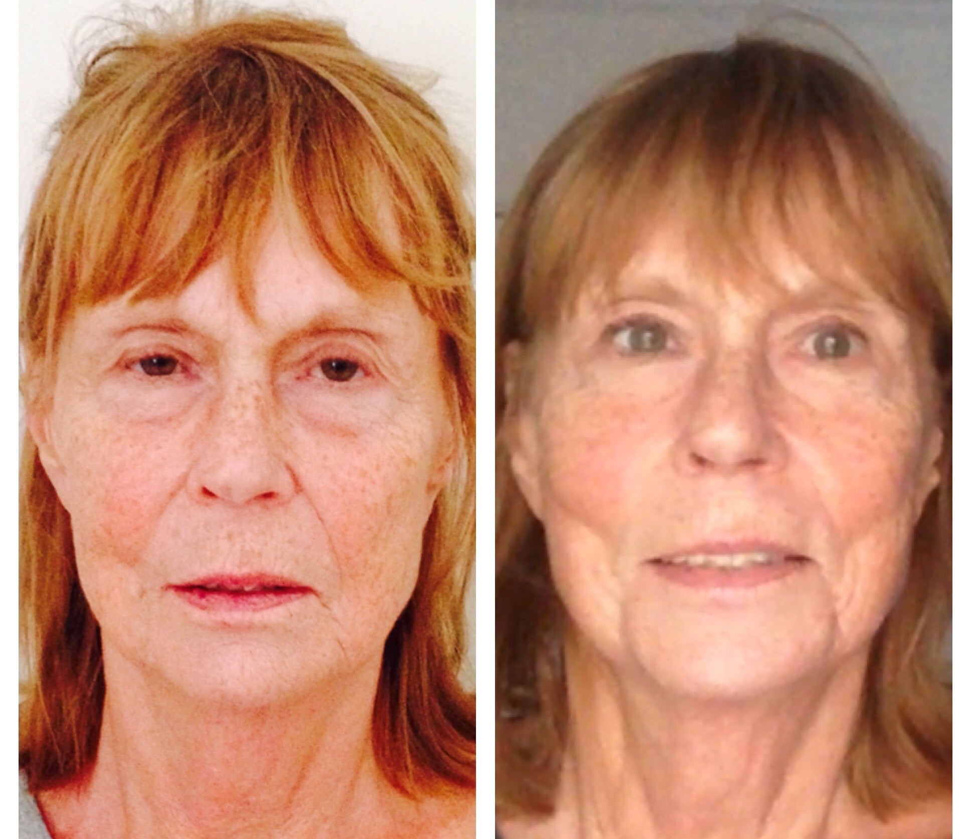 6 week antiaging case study for microcurrent and LED (and massage of course!)