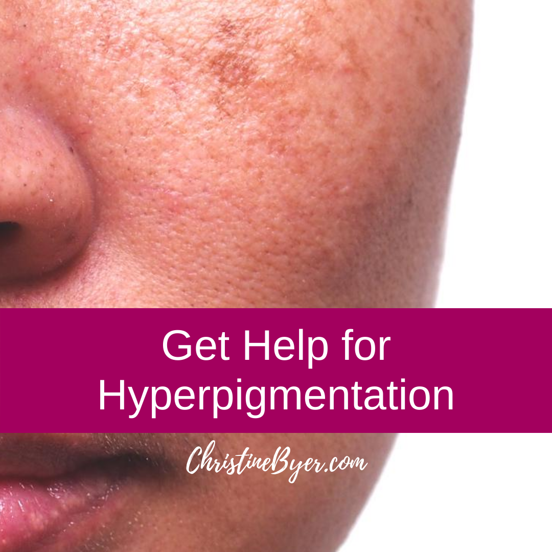 Get Help for Hyperpigmentation