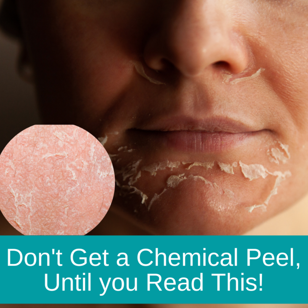 Don't Get a Chemical Peel, Until You Read This!