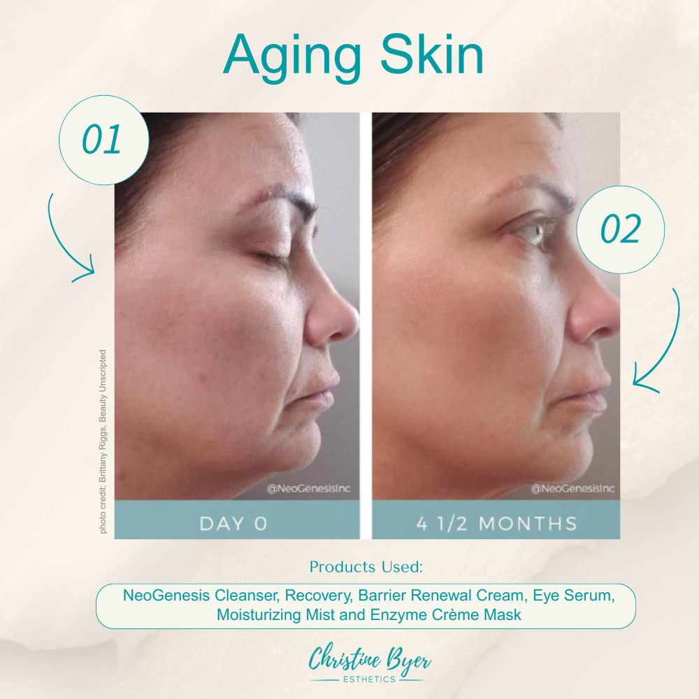 best time to start non-disruptive skin care after glp-1 therapy Restoring GLP-1 Face: Master Esthetician-Approved Skincare Protocol for Ozempic Face, Skin Sagging & Volume Loss – Christine Byer Esthetics