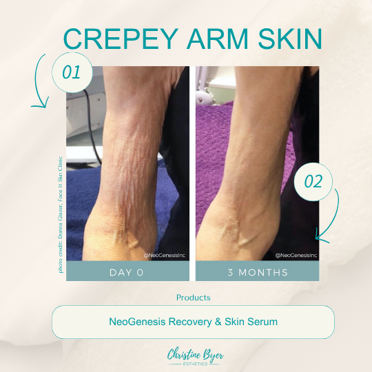 NeoGenesis Crepey Arm Bundle