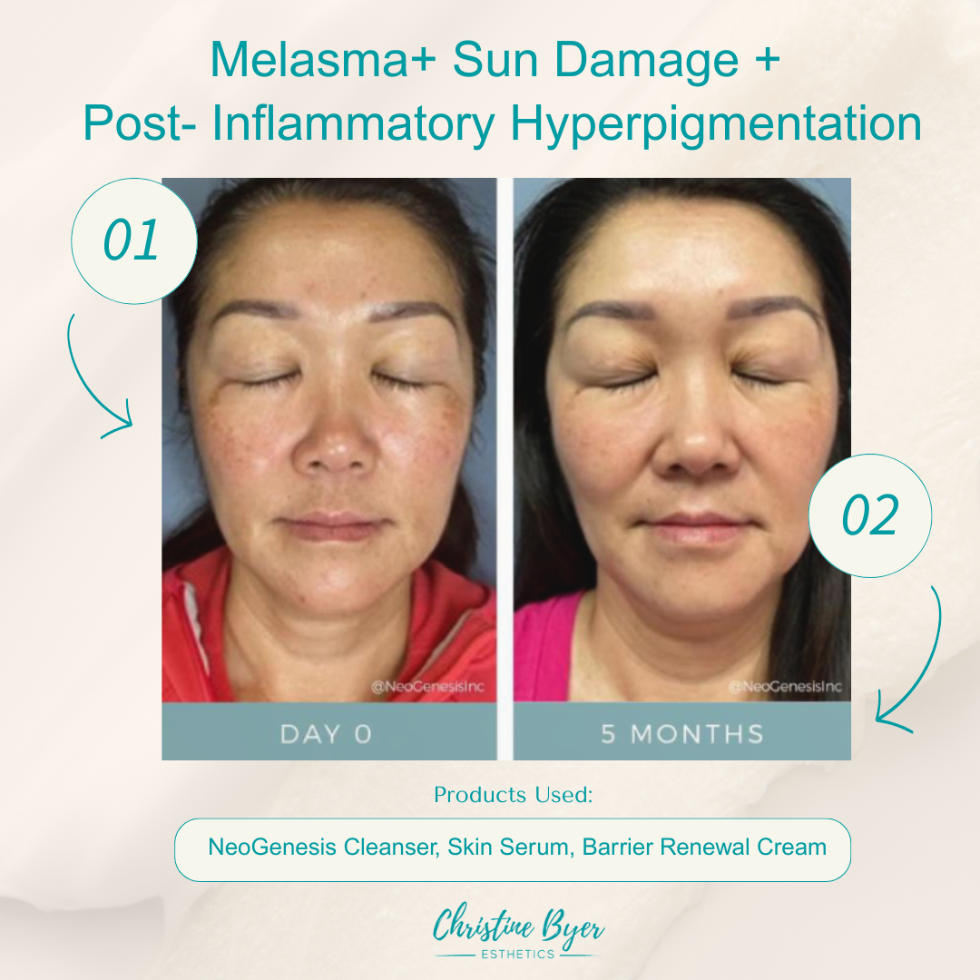NeoGenesis Barrier Renewal Cream on Christine Byer Esthetics NeoGenesis Barrier Renewal Cream on Christine Byer Esthetics