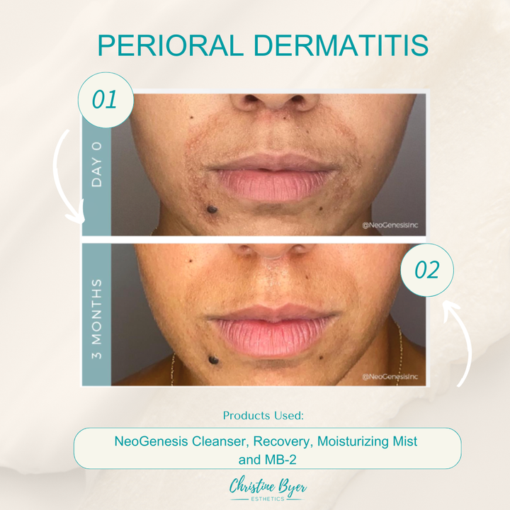 NeoGenesis MB-2 Probiotic Balm