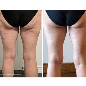 mbk curve legs back before and after